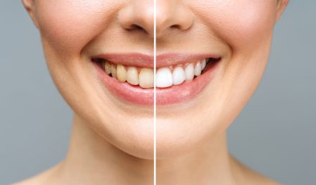 Woman Teeth Before And After Whitening