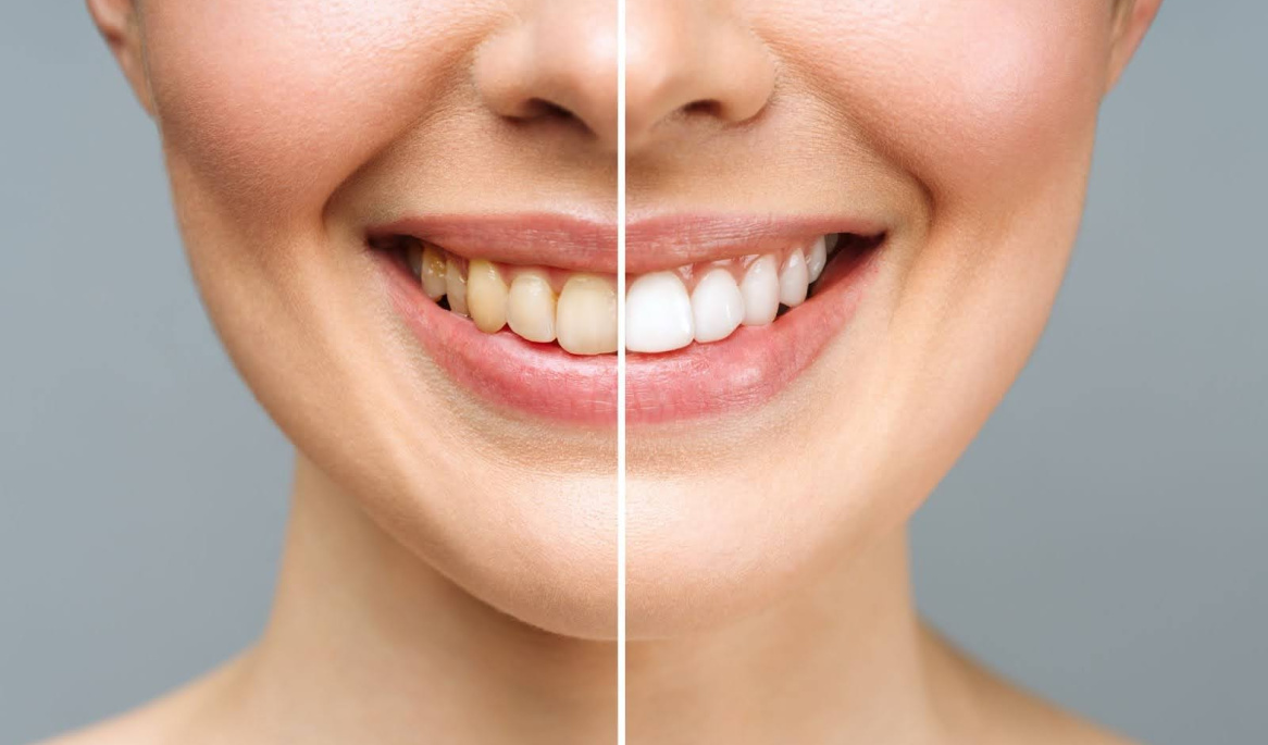 Woman With Teeth Whitening Treatment